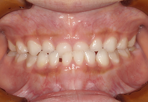 乳歯・永久歯の歯並びチェック